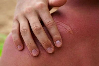 घमौरियों से राहत के लिए अपनाएं ये असरदार घरेलू उपाय
