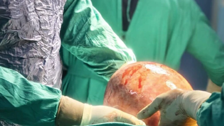 गुरुग्राम: 25 साल तक पेट को सूजन समझती रही महिला, जांच में निकला 7 किलो का ट्यूमर