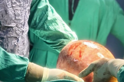 गुरुग्राम: 25 साल तक पेट को सूजन समझती रही महिला, जांच में निकला 7 किलो का ट्यूमर