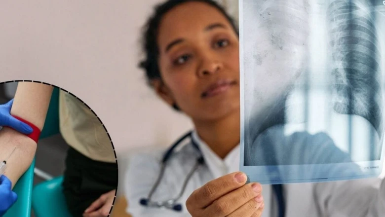 फेफड़ों के कैंसर का पता अब ट्यूमर बनने से 5.6 साल पहले! वैज्ञानिकों के नए ब्लड टेस्ट से बच सकती हैं लाखों जानें