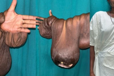 हाथ पर पनपता रहा 7 किलो का ट्यूमर, 30 साल की तकलीफ के बाद डॉक्टरों ने यूं दी नई जिंदगी