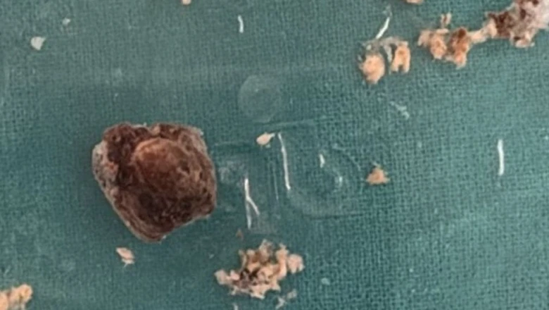 सात साल तक टीबी समझकर चला इलाज, आखिरकार महिला के फेफड़े से निकली एक इंच लंबी सुपारी