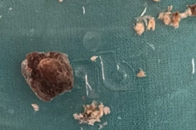 सात साल तक टीबी समझकर चला इलाज, आखिरकार महिला के फेफड़े से निकली एक इंच लंबी सुपारी