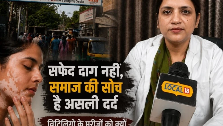 सफेद दाग छूने से नहीं फैलता! डॉक्टर से जानें विटिलिगो का सही कारण और इलाज