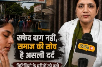 सफेद दाग छूने से नहीं फैलता! डॉक्टर से जानें विटिलिगो का सही कारण और इलाज