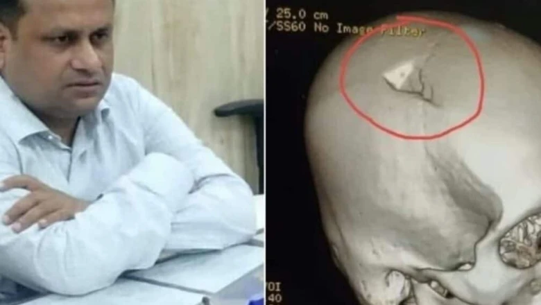 छपरा हिंसा: ड्यूटी पर तैनात बीडीओ रितेश कुमार सिंह के सिर की मेदांता अस्पताल में हुई जटिल सर्जरी