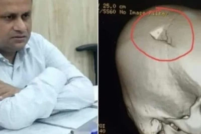 छपरा हिंसा: ड्यूटी पर तैनात बीडीओ रितेश कुमार सिंह के सिर की मेदांता अस्पताल में हुई जटिल सर्जरी