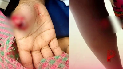 बालेश्वर में खौफनाक वारदात: शौचालय जाते मासूम छात्र पर आवारा कुत्ते ने किया हमला, उंगली काटी