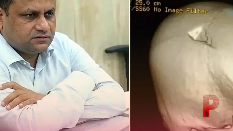 छपरा हिंसा: ड्यूटी पर तैनात बीडीओ रितेश कुमार सिंह के सिर की मेदांता अस्पताल में हुई जटिल सर्जरी