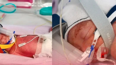 ऑस्ट्रेलिया: महिला ने दिया एक जैसी दिखने वाली 4 बच्चियों को जन्म, डॉक्टरों के लिए भी यह एक चमत्कारिक मामला