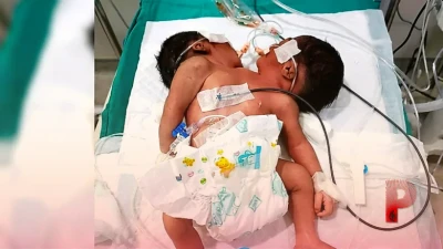 ओडिशा के कंधमाल में जन्मा दो सिर वाला दुर्लभ बच्चा, एम्स भुवनेश्वर के डॉक्टर कर रहे हैं गहन निगरानी